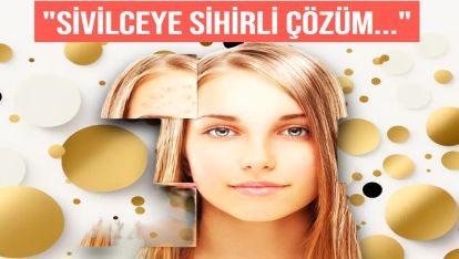 Sivilce sorununa köklü çözüm! Bakterilerin kökünü kazıyacak tedavi geliştirildi...